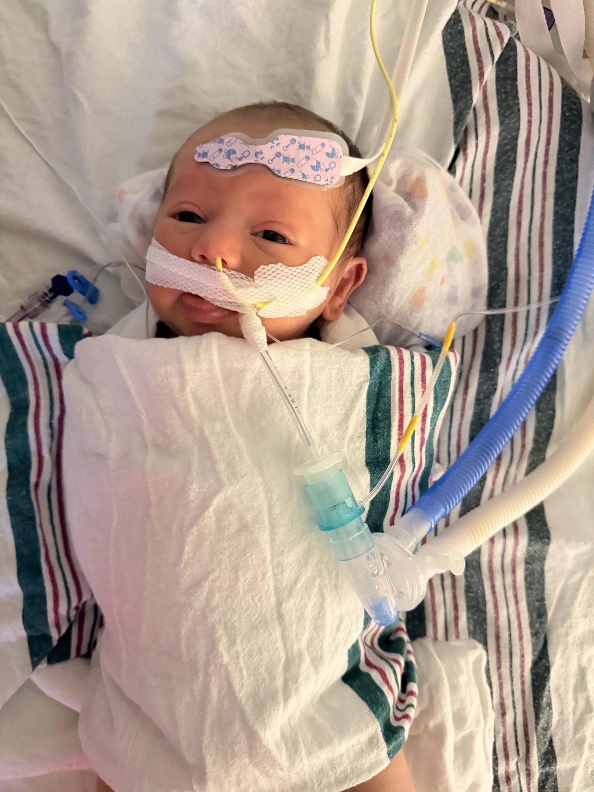 Tala smiling with her eyes open and her little tongue sticking out, a breathing tube taped at her mouth